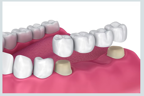 Fixed Dental Bridge Architecture — Tooth Replacement