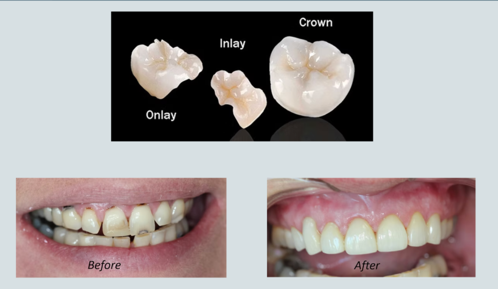 Dental Crowns, Inlays & Onlays — Clinical Restoration