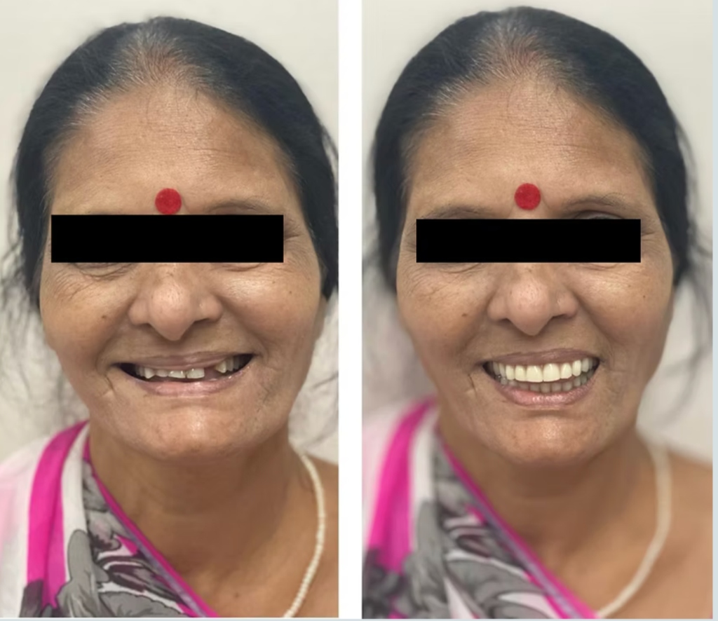 Complete Dentures — Before & After Full Smile Transformation