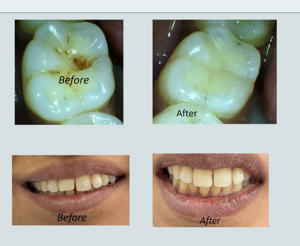 Clinical before and after results for molar tooth fillings and front teeth gap closure by Dr. Vrishali Gujar at V Family Dental