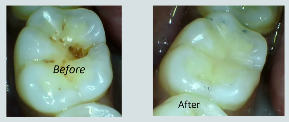 Molar Cavity Restoration — Clinical Before & After