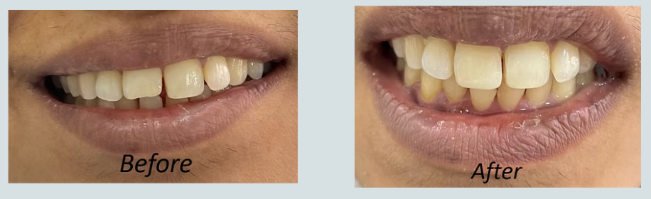 Aesthetic Gap Closure (Diastema) — Clinical Before & After