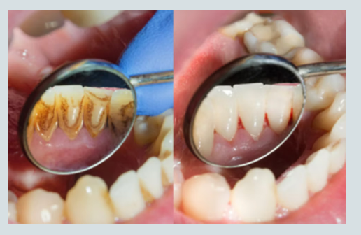 Gum Care & Periodontal Scaling — Before & After