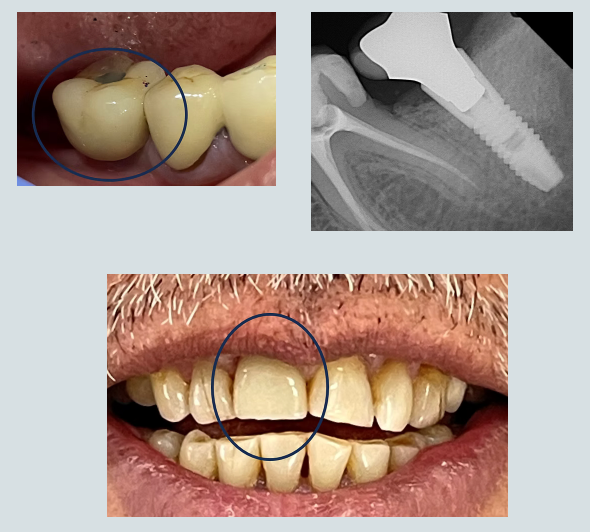 Dental Implant Surgery & Restoration — Clinical & Radiograph Case
