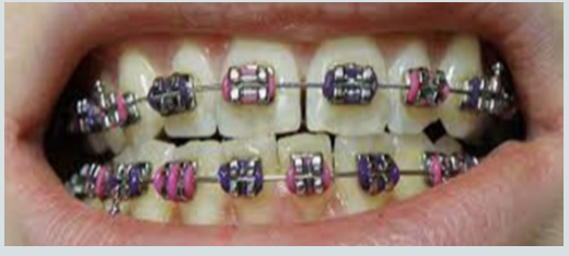 Orthodontic Metal Braces & Tooth Alignment
