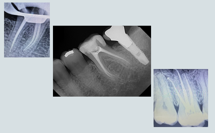 Precision Endodontic Root Canal Obturations — Clinical Radiographs