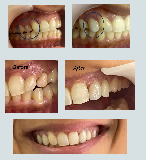 Veneers & Smile Design — Clinical Case Study